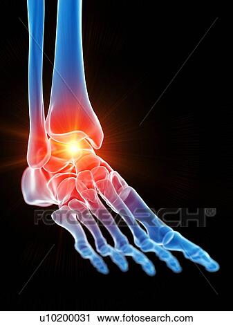 Ankle pain, illustration View Large Photo Image Stock Image - Ankle pain, illustration. Fotosearch