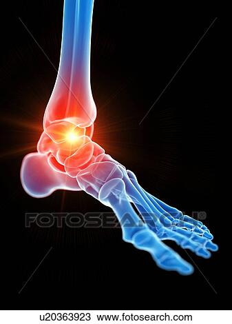 Ankle pain, illustration View Large Photo Image Stock Image - Ankle pain, illustration. Fotosearch