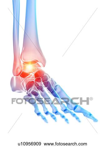 Stock Photo - Ankle pain, illustration. Fotosearch