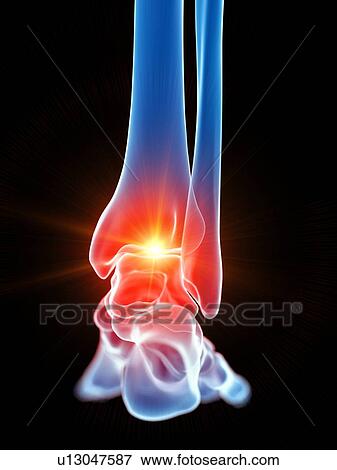 Ankle pain, illustration View Large Photo Image Stock Photo - Ankle pain, illustration. Fotosearch