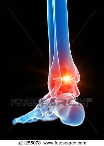 Stock Photo - Ankle pain, illustration. Fotosearch