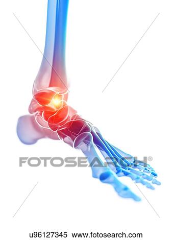 Ankle pain, illustration View Large Photo Image Stock Photography - Ankle pain, illustration. Fotosearch