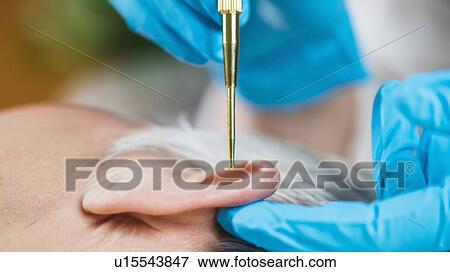 Stock Photo - Auricular therapy. Fotosearch
