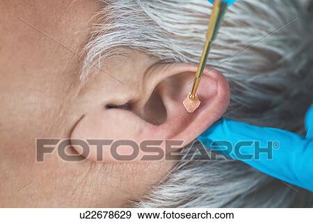 Stock Photo - Auricular therapy. Fotosearch