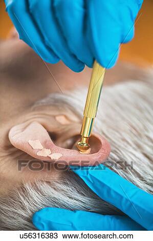 Stock Image - Auriculotherapy. Fotosearch