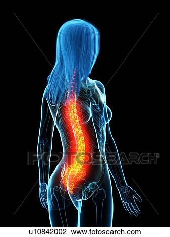 Stock Image - Back pain, conceptual illustration. Fotosearch