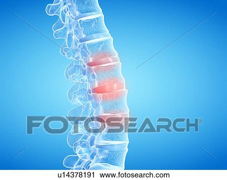 Stock Image - Back pain, conceptual illustration. Fotosearch