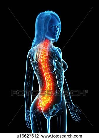 Stock Image - Back pain, conceptual illustration. Fotosearch