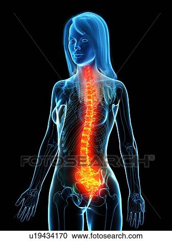 Stock Image - Back pain, conceptual illustration. Fotosearch