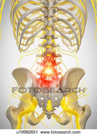 Back pain, conceptual illustration View Large Photo Image Stock Image - Back pain, conceptual illustration. Fotosearch