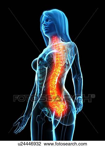 Stock Image - Back pain, conceptual illustration. Fotosearch