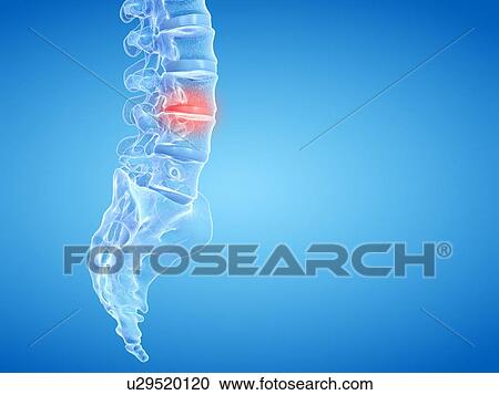 Stock Image - Back pain, conceptual illustration. Fotosearch