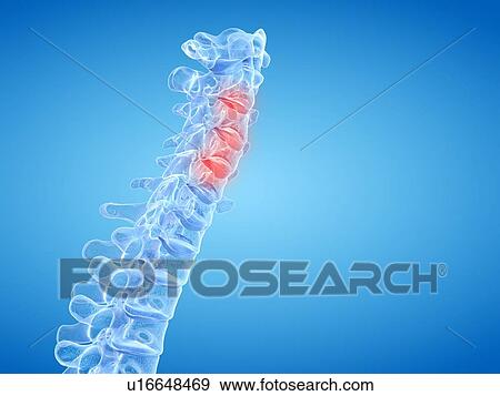 Back pain, conceptual illustration View Large Photo Image Stock Photo - Back pain, conceptual illustration. Fotosearch