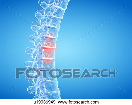 Back pain, conceptual illustration View Large Photo Image Stock Photo - Back pain, conceptual illustration. Fotosearch
