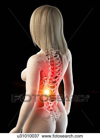 Stock Photo - Back pain, conceptual illustration. Fotosearch