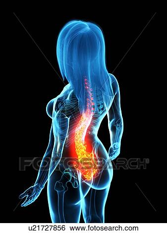 Back pain, conceptual illustration View Large Photo Image Stock Photograph - Back pain, conceptual illustration. Fotosearch