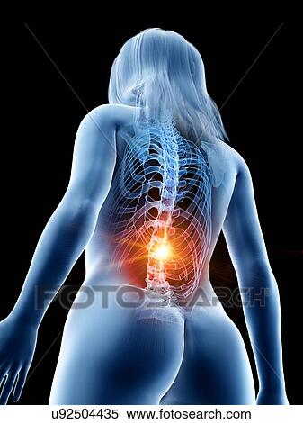 Stock Photography - Back pain, conceptual illustration. Fotosearch