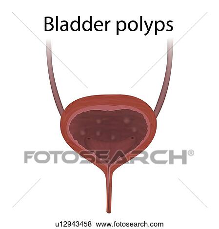 Bladder polyps, illustration View Large Photo Image Stock Photo - Bladder polyps, illustration. Fotosearch