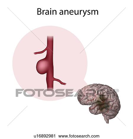 Brain aneurysm, illustration View Large Photo Image Stock Image - Brain aneurysm, illustration. Fotosearch