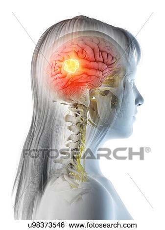 Stock Photograph - Brain cancer, conceptual illustration. Fotosearch