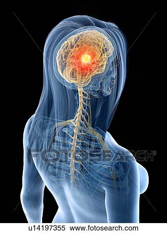 Brain cancer, conceptual illustration View Large Photo Image Stock Photography - Brain cancer, conceptual illustration. Fotosearch