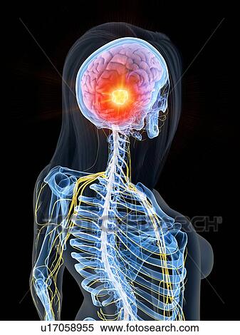Brain cancer, conceptual illustration View Large Photo Image Stock Photography - Brain cancer, conceptual illustration. Fotosearch