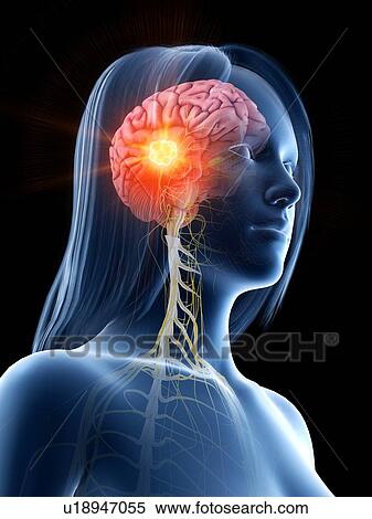 Brain cancer, conceptual illustration View Large Photo Image Stock Photography - Brain cancer, conceptual illustration. Fotosearch