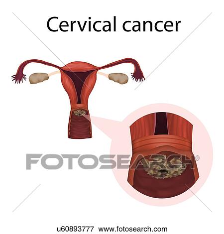 Stock Photo - Cervical cancer, illustration. Fotosearch
