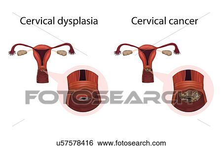 Cervical dysplasia and cervical cancer, illustration View Large Photo Image Stock Photograph - Cervical dysplasia and cervical cancer, illustration. Fotosearch