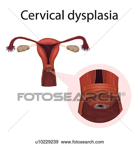 Stock Photo - Cervical dysplasia, illustration. Fotosearch