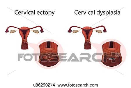 Cervical ectopy and cervical dysplasia, illustration View Large Photo Image Picture - Cervical ectopy and cervical dysplasia, illustration. Fotosearch