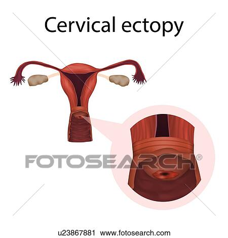 Cervical ectopy, illustration View Large Photo Image Stock Image - Cervical ectopy, illustration. Fotosearch