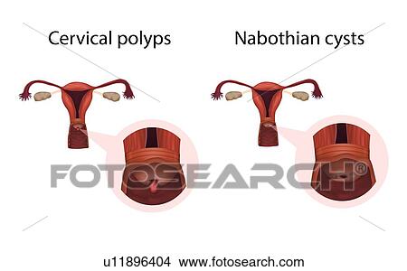 Picture - Cervical polyps and nabothian cysts, illustration. Fotosearch