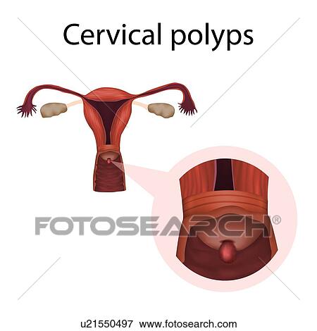 Cervical polyps, illustration View Large Photo Image Stock Photo - Cervical polyps, illustration. Fotosearch