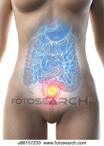 Colon cancer, conceptual illustration View Large Photo Image Stock Image - Colon cancer, conceptual illustration. Fotosearch