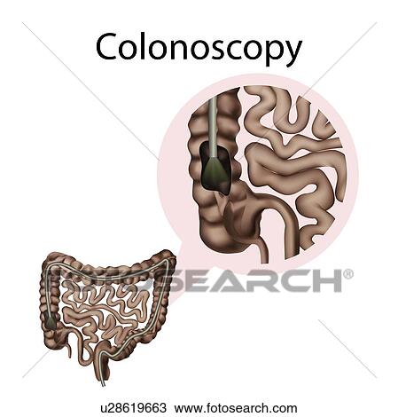 Colonoscopy, illustration View Large Photo Image Stock Image - Colonoscopy, illustration. Fotosearch