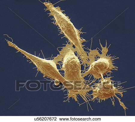 Colorectal cancer cells, SEM View Large Photo Image Stock Image - Colorectal cancer cells, SEM. Fotosearch
