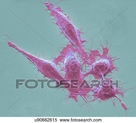 Stock Photography - Colorectal cancer cells, SEM. Fotosearch