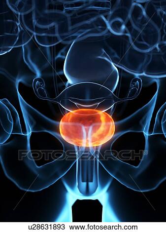 Diseased bladder, illustration View Large Photo Image Stock Image - Diseased bladder, illustration. Fotosearch