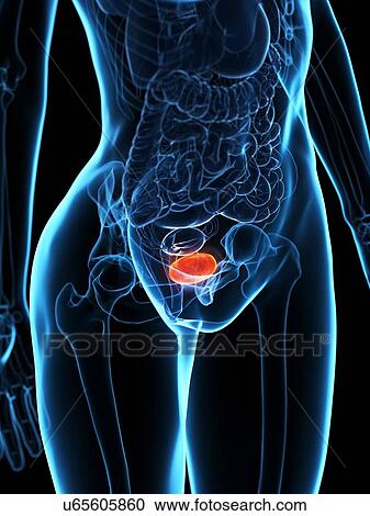 Stock Image - Diseased bladder, illustration. Fotosearch