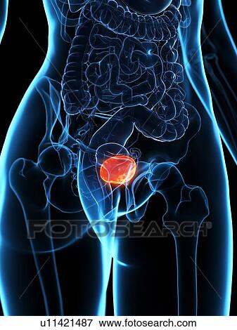 Diseased bladder, illustration View Large Photo Image Stock Photo - Diseased bladder, illustration. Fotosearch