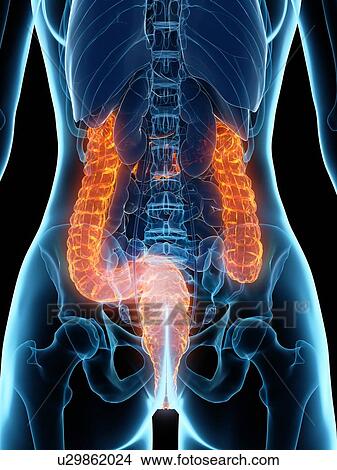 Picture - Diseased colon, illustration. Fotosearch