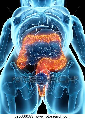Stock Image - Diseased colon, illustration. Fotosearch