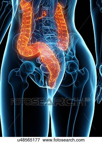 Diseased colon, illustration View Large Photo Image Stock Photo - Diseased colon, illustration. Fotosearch