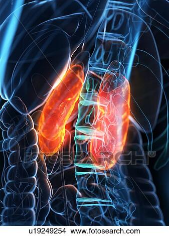 Diseased kidneys, conceptual illustration View Large Photo Image Picture - Diseased kidneys, conceptual illustration. Fotosearch