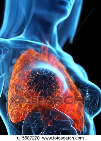 Stock Image - Diseased lung, illustration. Fotosearch