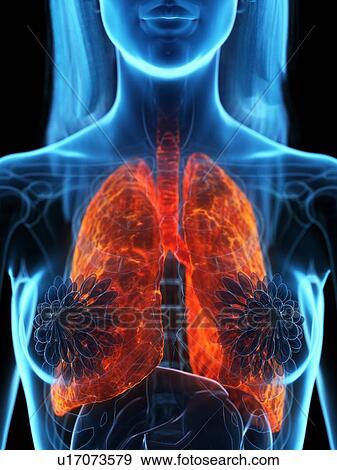 Diseased lung, illustration View Large Photo Image Stock Photo - Diseased lung, illustration. Fotosearch