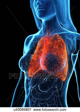 Stock Photo - Diseased lung, illustration. Fotosearch