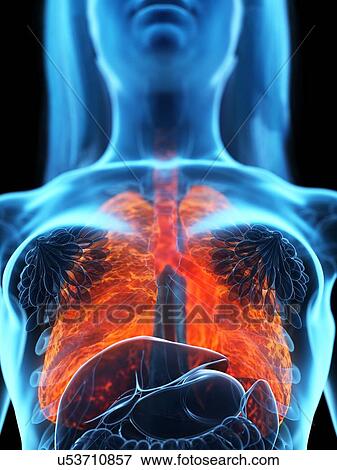 Diseased lung, illustration View Large Photo Image Stock Photo - Diseased lung, illustration. Fotosearch