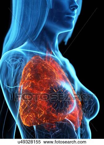 Stock Photography - Diseased lung, illustration. Fotosearch